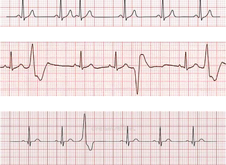 Disease detection on heart-beats using deep learning